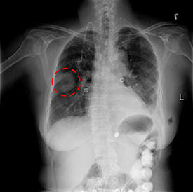 Xray of chest showing lungs, spine, and other bones. Lung mass is circled in red.