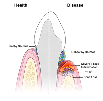 illustration of cross section of tooth and gum line