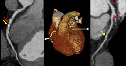 3D image of heart and detail of blood vessels