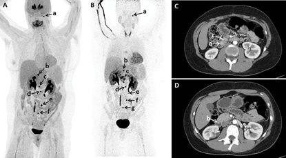 images of patient with multiple tumors