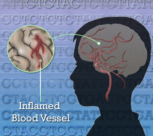 illustration brain with inset for inflamed area