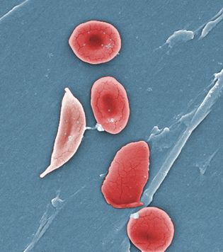 red blood cells--normal and sickled
