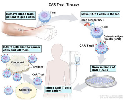 illustration showing steps in CAR-T-cell therapy