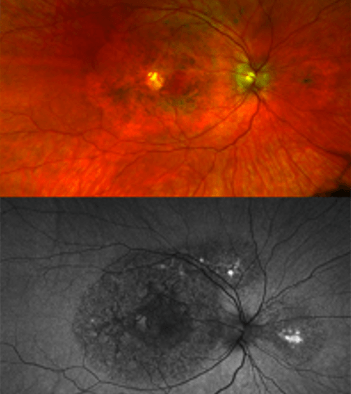 IRP researchers discover new genetic eye disease