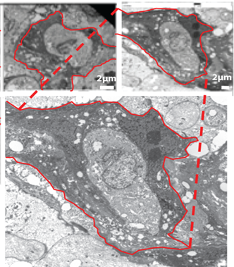 macrophage that has engulfed a cancer cell