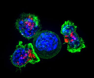 Immune cells known as killer T cells surround a cancer cell