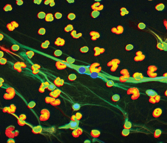 Low-density granulocytes isolated from a patient with systemic lupus erythematous are visualized using a laser confocal microscopy