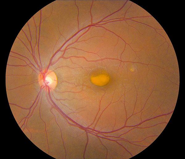 High-tech imaging reveals details about rare eye disorder