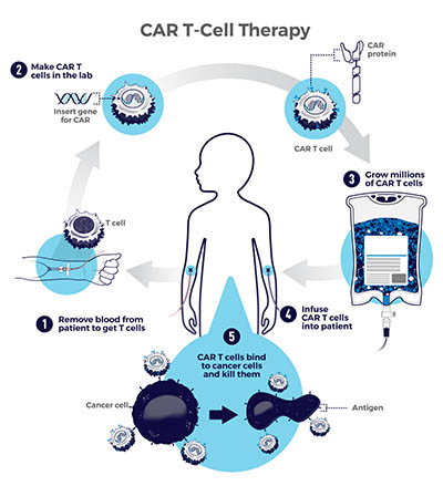 CAR T-cell therapy: 1, Remove blood from patient to get T cells. 2, Make CAR T cells in the lab. 3, Grow millions of CAR T cells. 4, Infuse CAR T cells into patient. 5, CAR T cells bind to cancer cells and kill them.