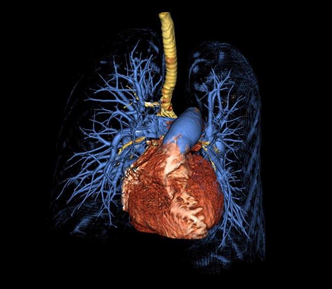 Novel blood test helps evaluate severity in pulmonary arterial hypertension, a rare lung disease