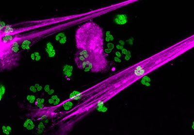 Immune cells called neutrophils producing neutrophil extracellular traps (purple) to prevent infection.