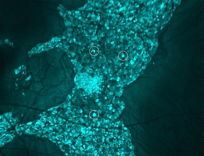 Novel imaging approach reveals important details about rare eye disease choroideremia