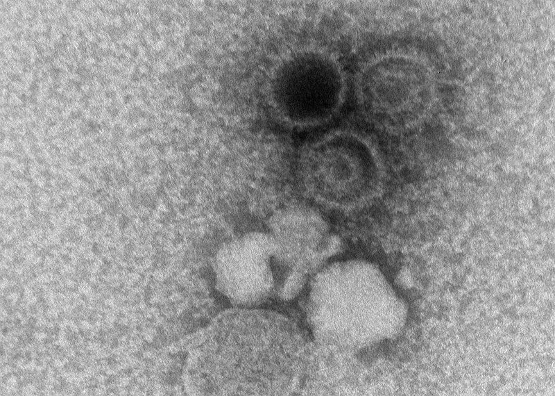 An electron microscopy image showing three Epstein-Barr virions
