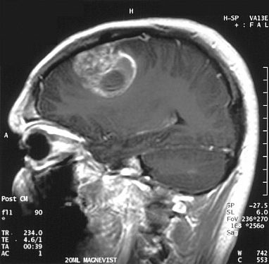 MRI showing glioblastoma tumor in the brain