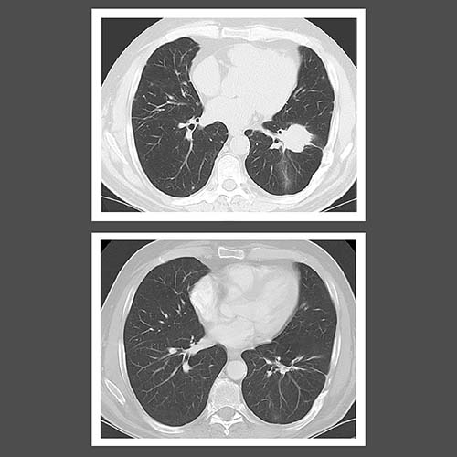 comparison of chest CT scans pre- and post-treatment with interferon alfa-2b