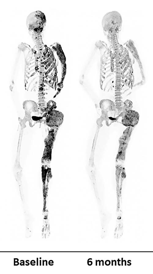 Bone scans of a patient before (left) and after (right) a six-month denosumab treatment show reduced turnover within fibrous dysplasia lesions (dark-colored patches)