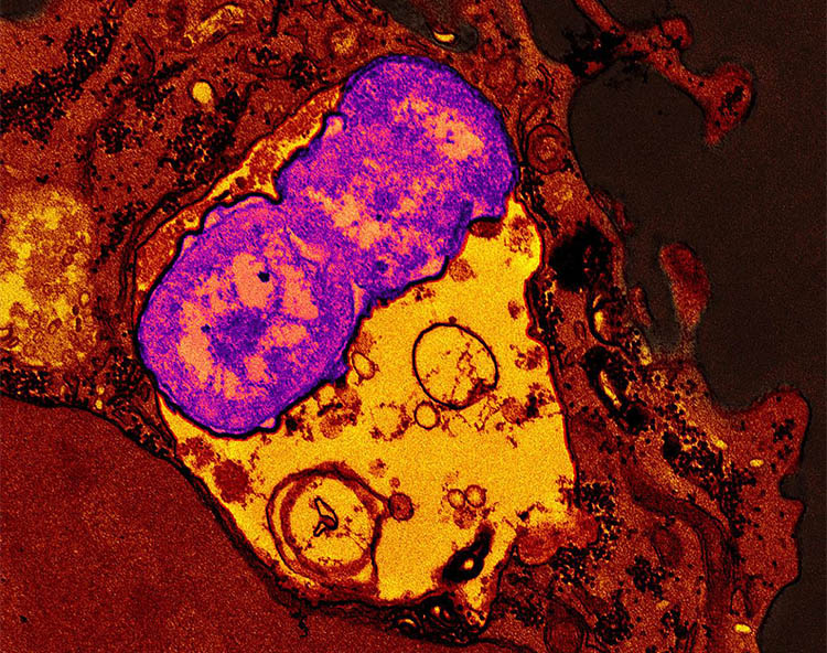 a human neutrophil (red) containing ingested Klebsiella pneumoniae (purple)