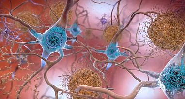 neurons surrounded by amyloid plaques (blue) and tau tangles (brown)