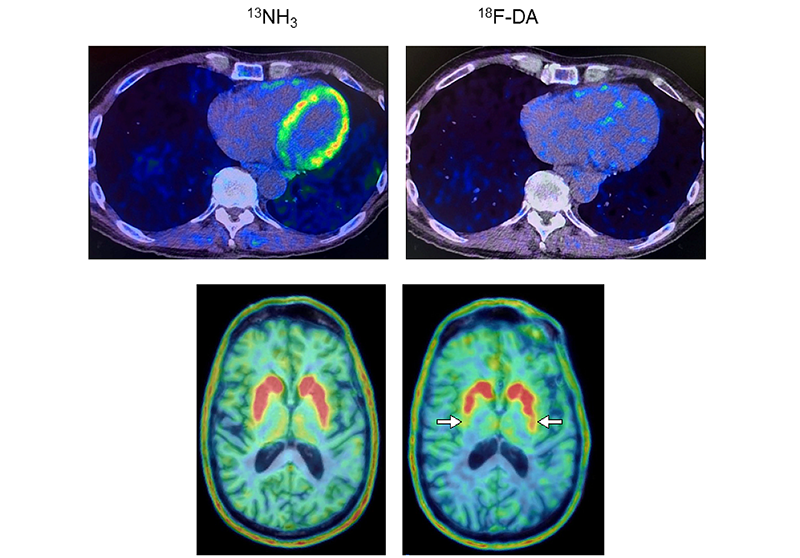 Heart and brain PET scans from a study participant who developed Parkinson’s disease