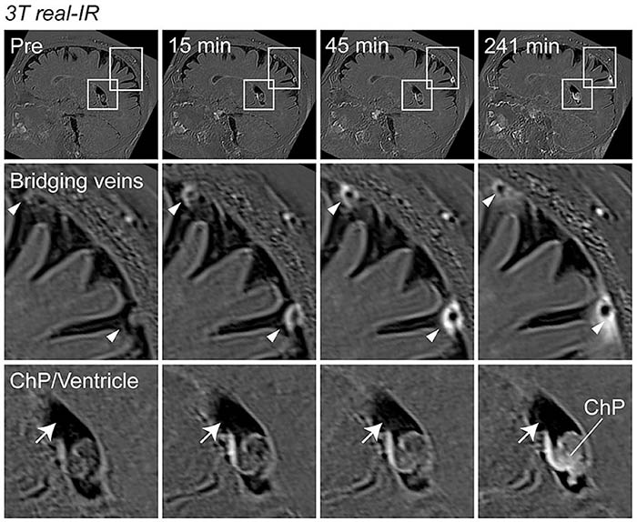 MRI images showing fluid containing light-emitting molecules slipping through the arachnoid barrier where blood vessels pass through