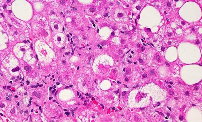 A microscopic image of liver tissue affected by non-alcoholic fatty liver disease