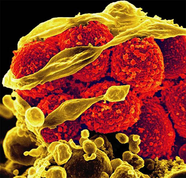 Scanning electron micrograph of methicillin-resistant Staphylococcus aureus bacteria (red, round items) killing and escaping from a human white blood cell.