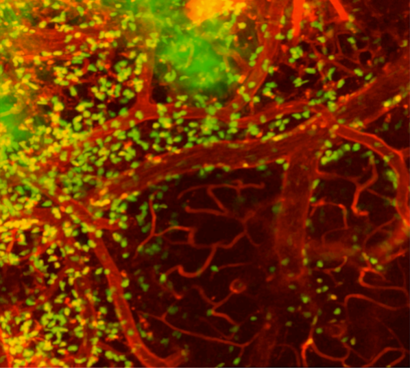 massive infiltration of inflammation-inducing immune cells (green) swarming around blood vessels in the brain of a mouse model designed to mimic human strokes