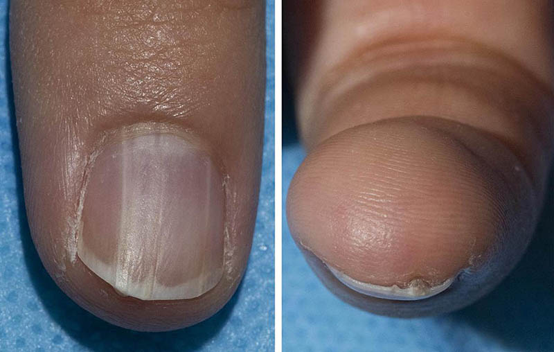 A fingernail with onychopapilloma