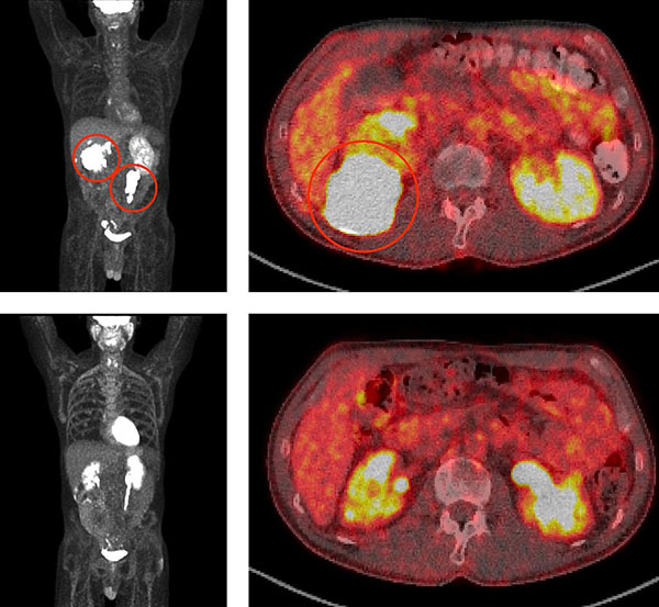 Image of medical scans that show shrinking tumors in a patient with large lymphoma tumors