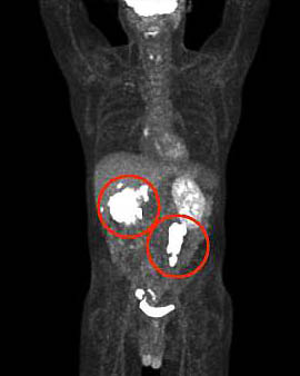 abdominal PET scan showing tumors