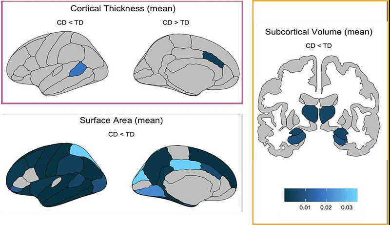 Brain plots showing regions with significant group differences between youth with and without conduct disorder