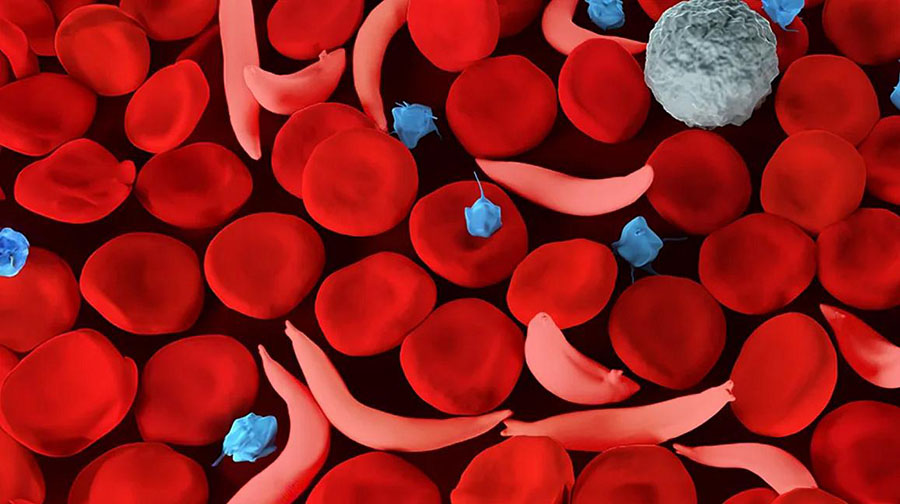 normal and sickled red blood cells