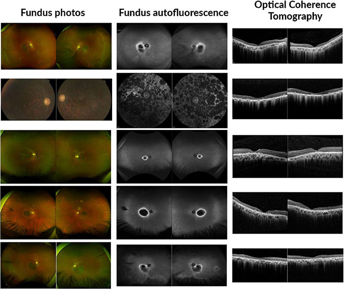 Ophthalmic images from the study probands exhibit variable forms of retinal dystrophy