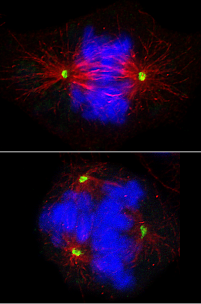 A Merkel cell carcinoma cell dividing to make two daughter cells. Bottom: Disrupted cell division in a Merkel cell carcinoma cell caused by treatment with an aurora kinase B inhibitor.