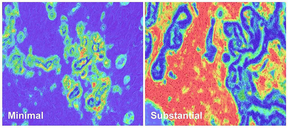 Slides showing minimal disruption (left) and substantial disruption (right) in breast stromal tissue