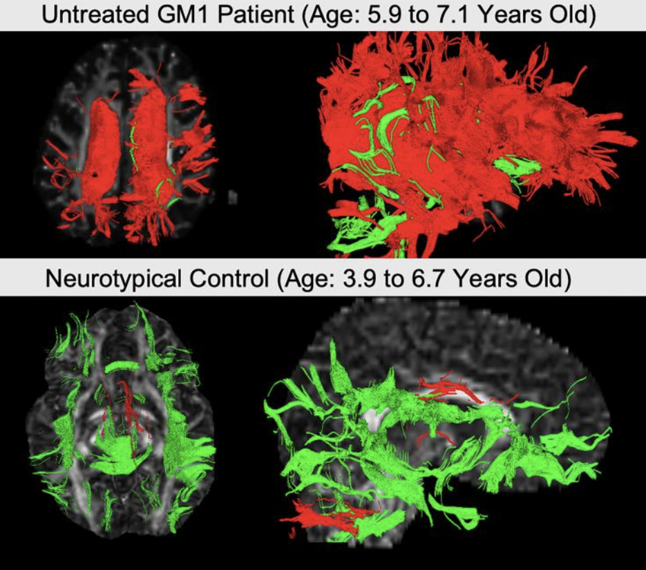 These two images from the study, produced using differential tractography, show neuronal connections that shrank (red) or grew (green) over time in a child with GM1 gangliosidosis (top) and a healthy child (bottom).