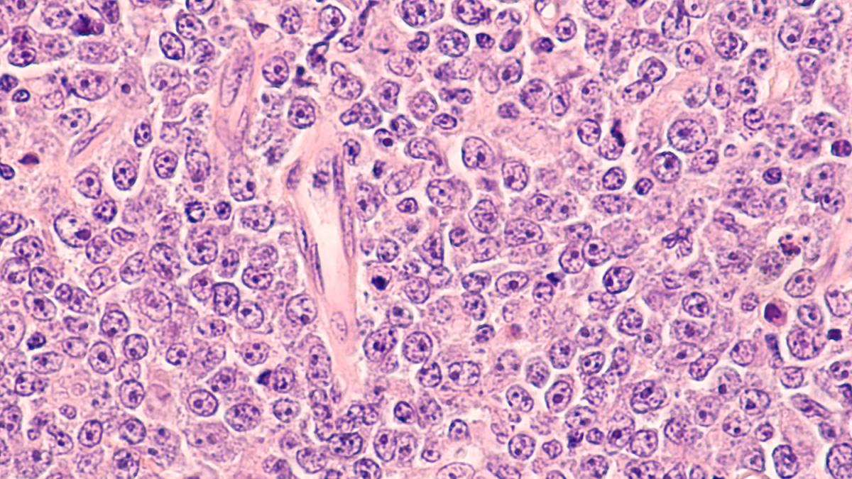 diffuse large B cell lymphoma, a type of non-Hodgkin lymphoma, as seen under a microscope