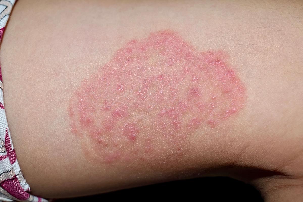 skin rash