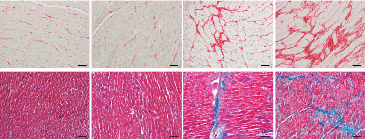 comparison of cardiac fibrosis in young and old rats that did and did not consume alcohol (fibrosis show in red on top and blue on bottom)