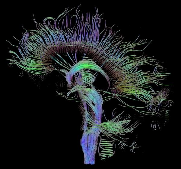 map of white matter tracts in the human brain