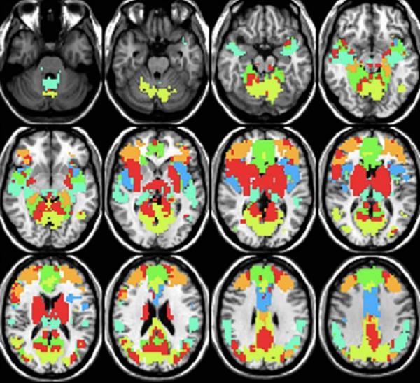 MRI images showing connectivity between different parts of the brain