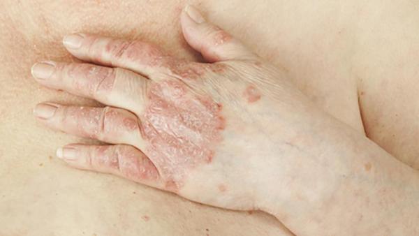 psoriasis skin rash on hand