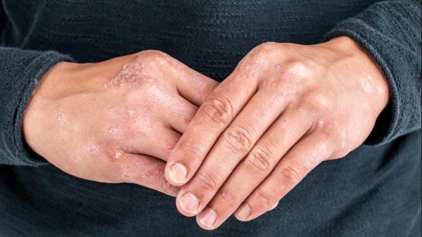 hands with rash caused by psoriasis
