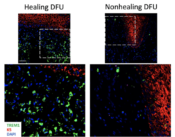 image from the study shows higher levels of the molecule created by the TREM1 gene (green) in DFUs that healed compared to those that did not