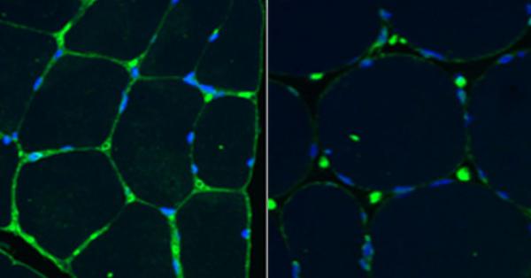 muscle biopsy slides showing sialic acid in green and cell nuclei in blue. Sialic acid is abundant in the muscle membranes of a healthy control (left), but levels are much lower in the muscle tissue of a patient with GNE myopathy (right).