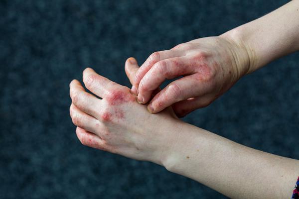 person with eczema on their hands