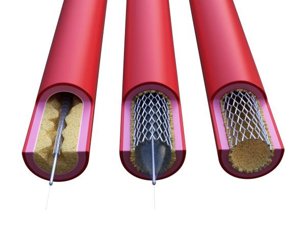 illustration of how a stent widens a blood vessel