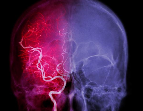 purple and red image showing blood vessels in the brain
