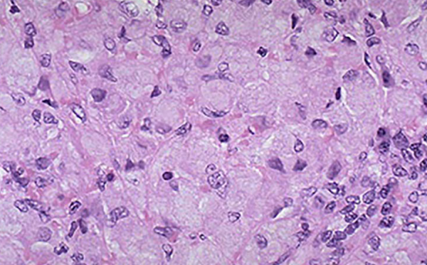 Enlarged cells stuffed with lipids in the spleen of a person with Gaucher disease