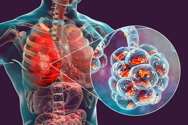 bacterial cells in lung alveoli